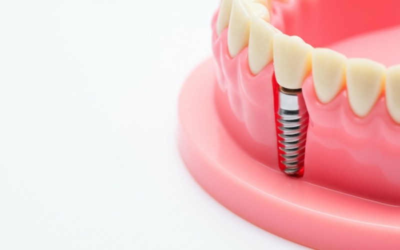 Dental implant cover screw beneath gum tissue