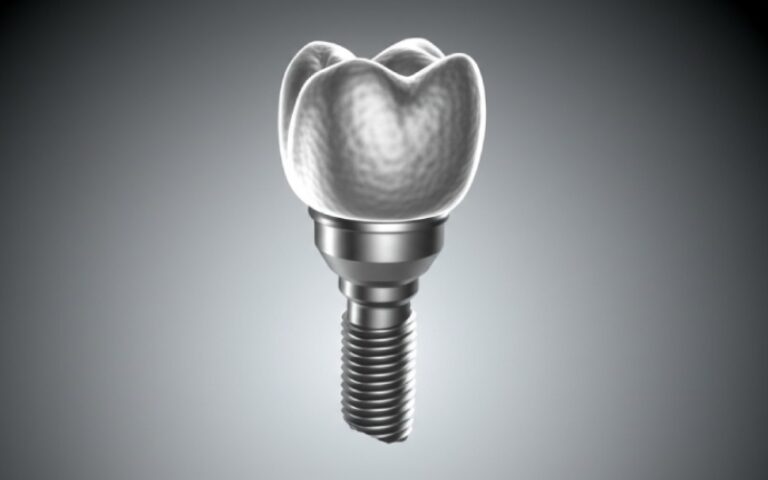 Dental implant integration with jawbone