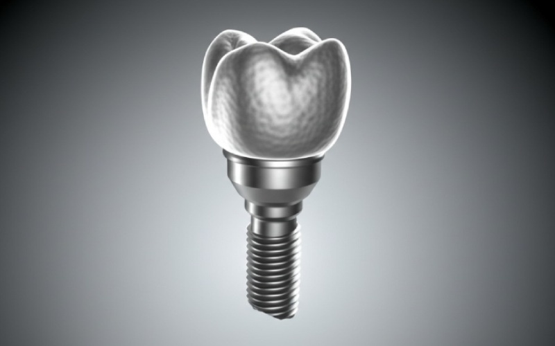 Dental implant integration with jawbone