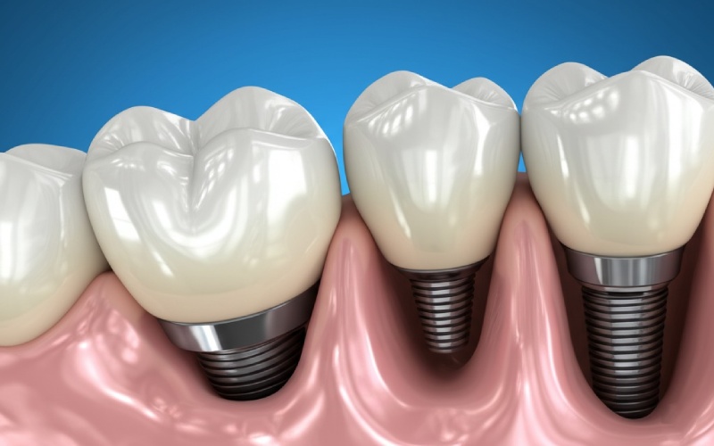 Dental implants placed in jawbone illustration