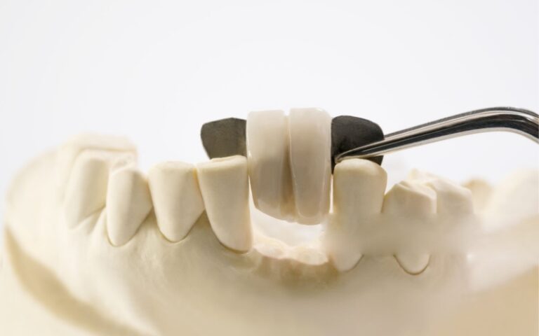 Maryland dental bridge on front teeth model