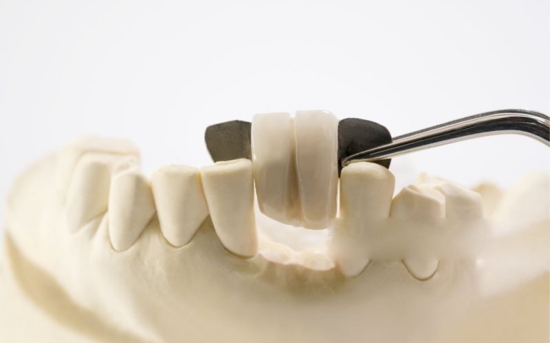 Maryland dental bridge on front teeth model