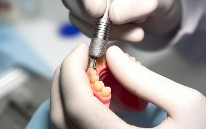 Tooth preparation for zirconia crown