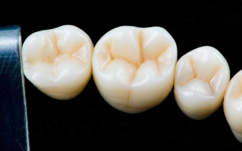 Tooth preparation with visible shoulder margin for PFM crown