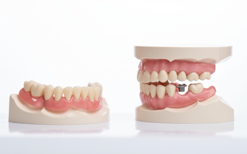 Traditional denture compared to implant-supported bridge