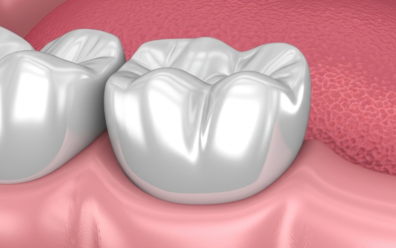 Zirconia crown cross-section on prepared tooth