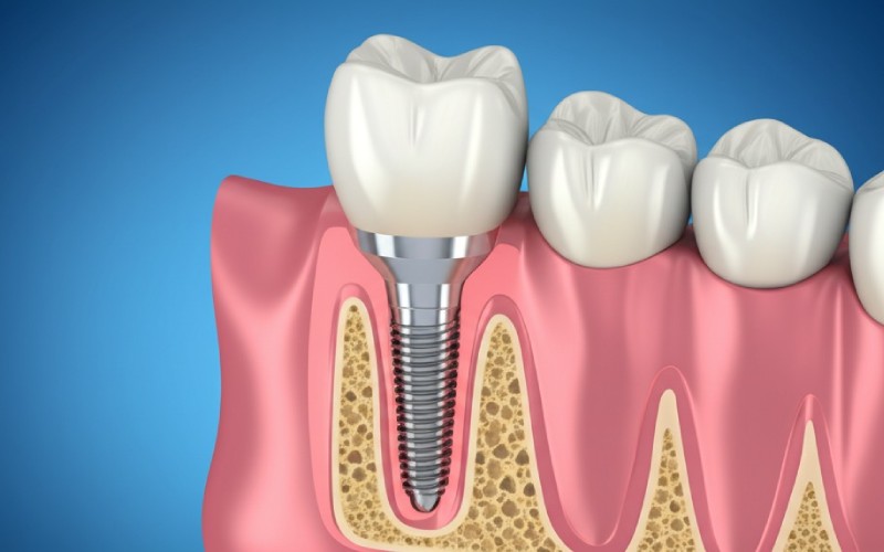 dental implant in jawbone