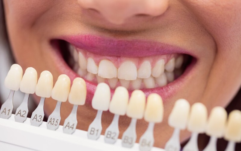 Dentist matching tooth shade with VITA guide