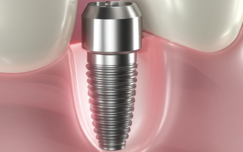 Rendu 3D d'un implant dentaire en cours de cicatrisation dans l'os de la mâchoire