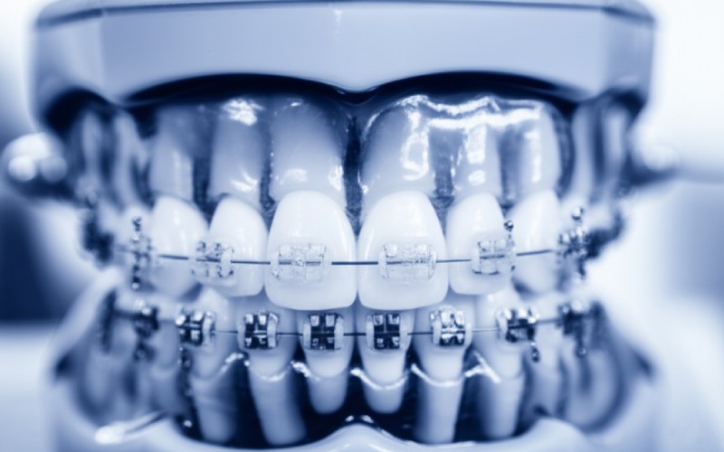 A dental model with ceramic braces