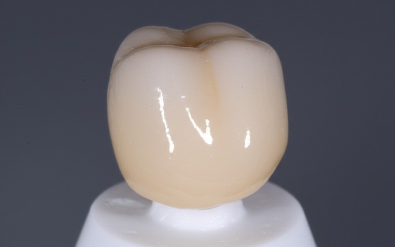 A finished PFM dental crown