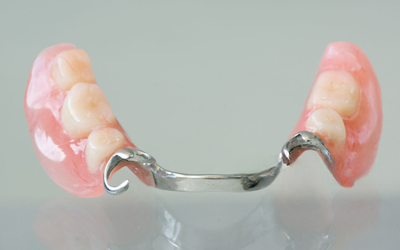 A single-tooth partial denture