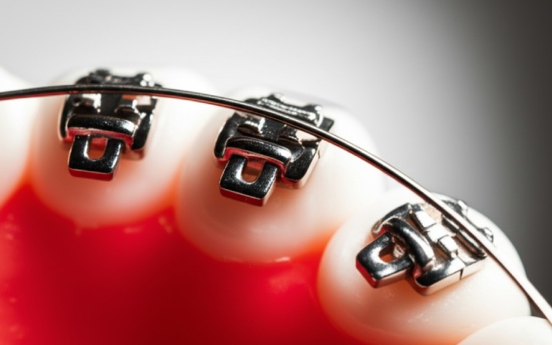 Close-up of modern orthodontic technology