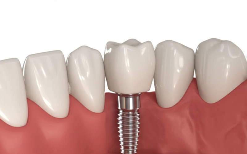 Dental implant integrated with natural teeth