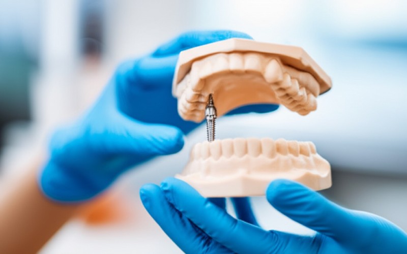 Dentist holding a jaw model with an implant