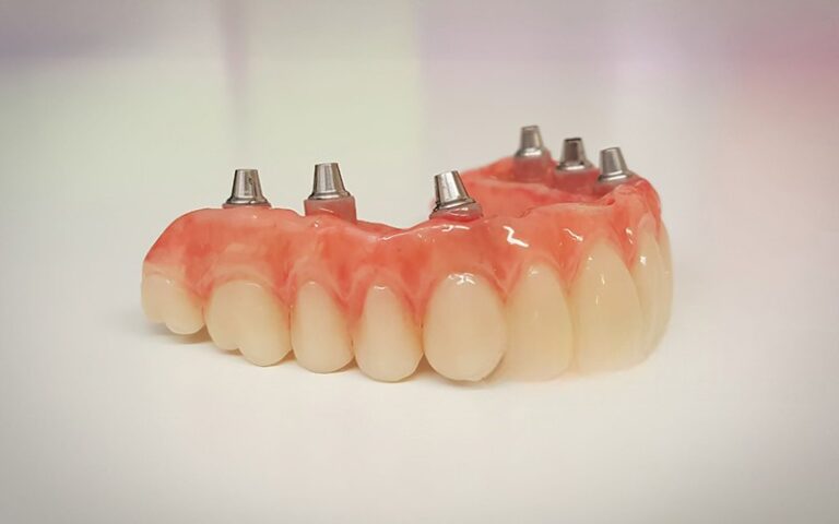 Denture Implant vs Dentures