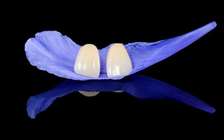 Emax-Veneer-1