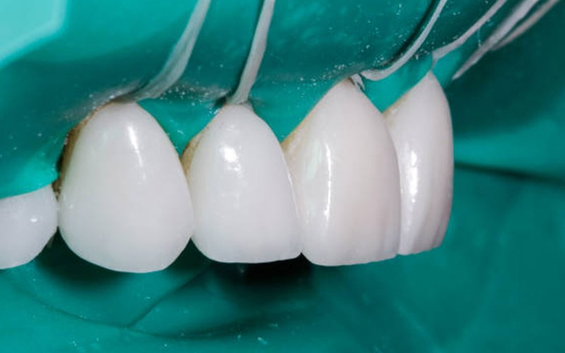 Emax-Veneer