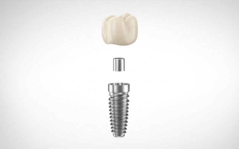 Exploded view of a dental implant