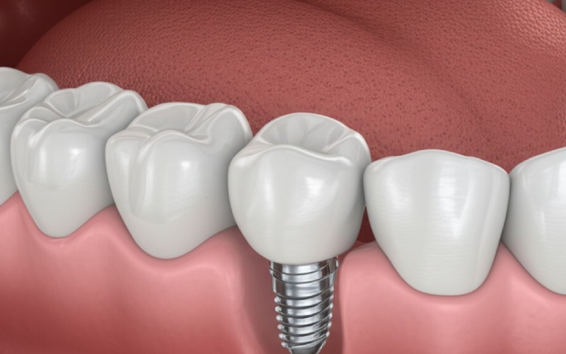 Flawless dental implant crown