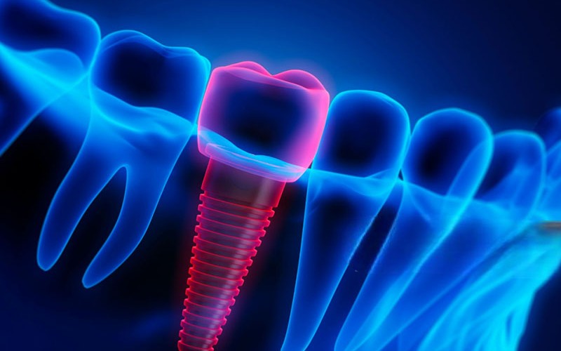 Implant Crown Cost-1