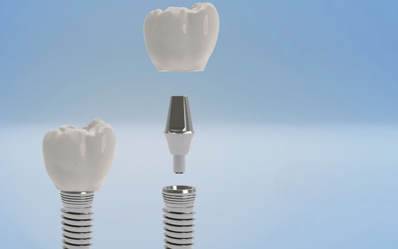 Implant Crown Cost-2