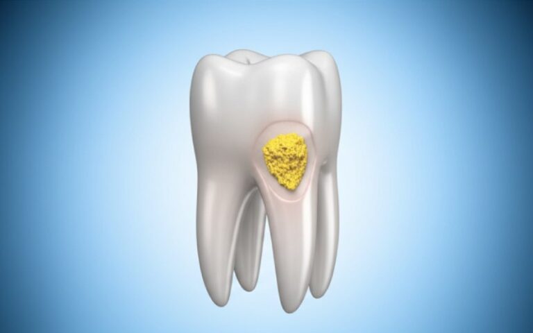 Macro view of tartar on a tooth