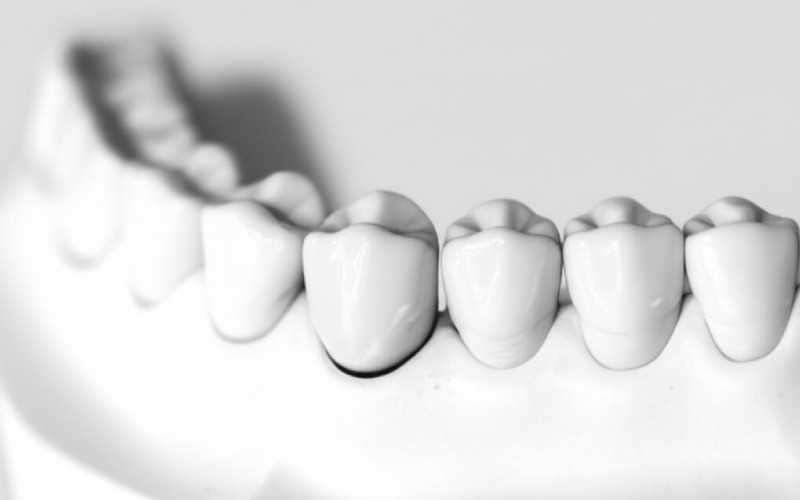 Model of a tooth prepared for a crown