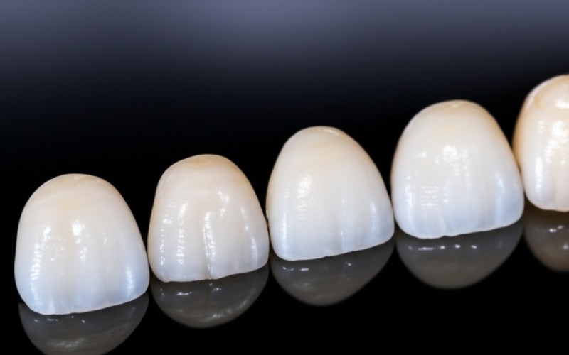 Translucent incisal edges of zirconia crowns