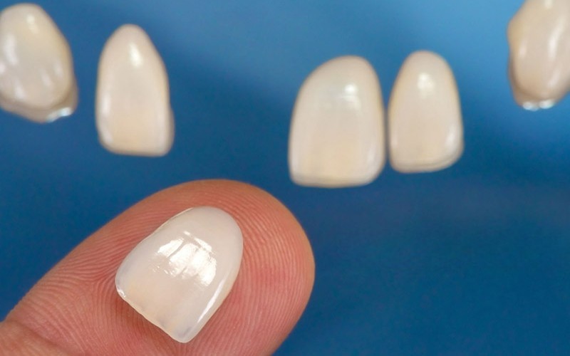 emax veneers