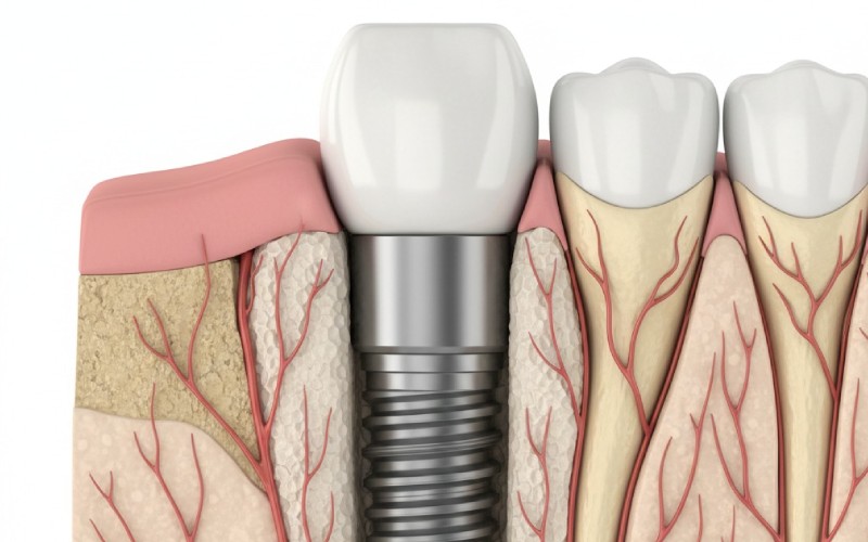 Dental implant integrated with jawbone