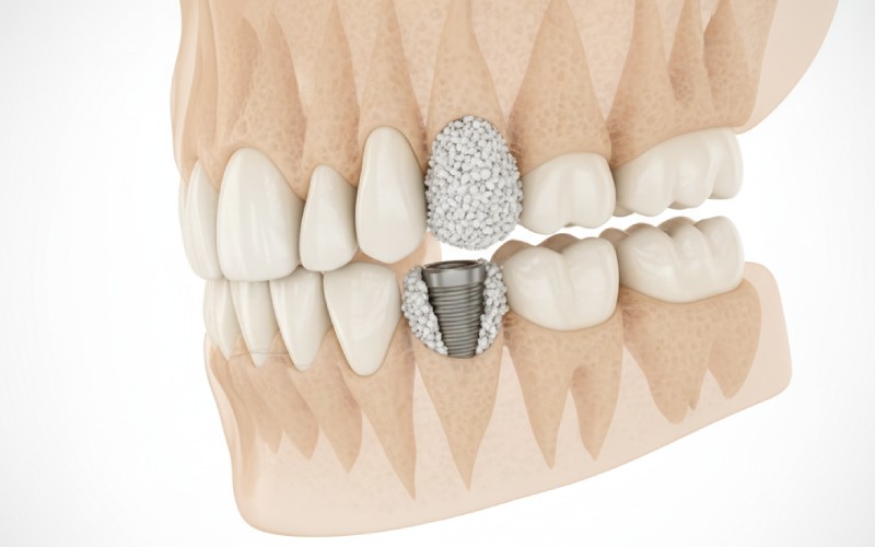 jawbone with dental bone graft
